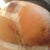 Day 6 post op - Underneath left breast