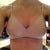 You can see the bruising underneath where the surgical bra had TIGHTLY adhered to my skin. Hope it vanishes away quickly in time!