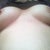 10 day po scars