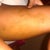 Bruising in the inside of leg.