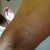 Brusing on the back of leg