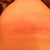 Right incision at 2wks