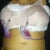 This was me with my drain..horrible! doing this but ladies so helped with the swelling so keep them in as long as possible. And my belly was so extended from the operation.