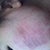 skin bern on right side