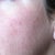 One year after Fraxel.  I have orange peel with underlying cottage cheese look, hyper and hypo pigmentation, broken caps with overal redness, and weird lines.