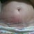 Post op day 3, insision