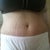 Post op day 4