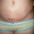 Incision line- 3 weeks PO