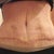 scar 1 month PO. bruises almost gone yay!