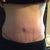 4.5 weeks post op....my scar is healing nicely but still swollen over my scar