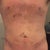 3 day post. A little more bruising and some swelling around belly button.