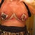 1 DAY POST OP