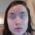 1 month 2 days, skin is not bad but not perfectly clear. Overall I'm happy that it doesn't look too terrible and red marks are fading!