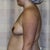 before surgery 10-12-2010