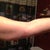 1 week back of arm