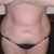 1 week before surgery