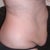 other side view before surgery