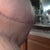 seroma