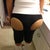 8 hours after surgery wearing garment
