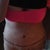 One week post op