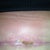Here is the problem area @ 51 days post op.  It has finally stopped draining, and appears to be almost healed.