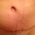 3 1/2 weeks post op