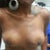 Breast lift (no implant) 6 days PO