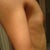 before side view - talking about 32AAA (if that is even a size..hey at least my breast was smart! all A's)