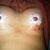 1 day post-op.  The surgical tape is giving rashes so I took them out.  some bruising on the left breast.