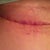 Scar after tape came off 3.5 weeks (tape is now replaced). Pic is upside down - not sure why