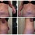 2 Week Post- Close Up Side and Stomach