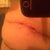 left side with wound where drain was that I accidently pulled 1 week post op. getting better day by day