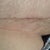 my scar up close, its really fading well and very low.