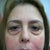 This is after the initial 1 1/2 vials...red and swelling went away in 5 days