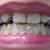 Day 1 With Invisalign 8-20-12