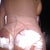 1 day postop