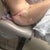 2 days PO - bruising from the outer thigh lipo