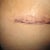 Up close incision, winkled, pinched and raised.  Scary but I KNOW it will be fine later. PO day 3