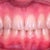 Front view, after some tooth reshaping. My ortho said he will shape them more once the whole process is complete and the bite is fixed.