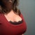 30 Days Post-Op