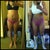 3/1/12 day before surgery front and the day after surgery 3/3/12