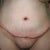 Day 3 post op-front view. Looks crooked, but not standing straight.