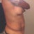 Before- Side View 11/14/12