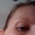 6 months after fraxel, right cheek