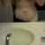 Post op day 6  drain out