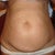 Tummy Tuck pre op, front view