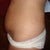 Tummy Tuck pre op, side view