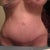 8 weeks post op.."the scar" still bright red!! I hope that it doesn't stay this red!!!