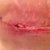 Left hip scar - Day 13 Post Op