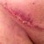 Right groin scar - Day 13 Post Op